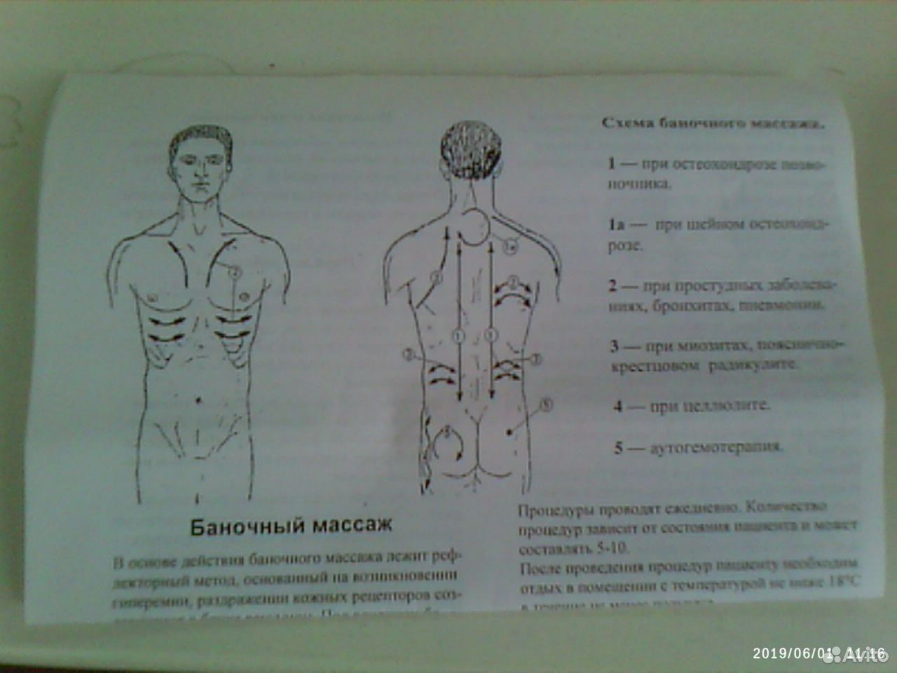 Как правильно ставить банки на спину при кашле взрослому схема