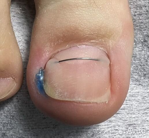 Подолог, педикюр медицинский, вросший ноготь