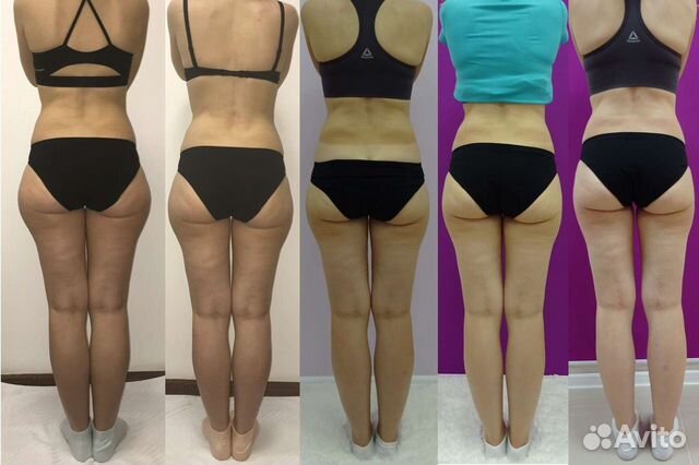 Антицеллюлитный массаж, ручная липосакция в Москве | Услуги | Авито