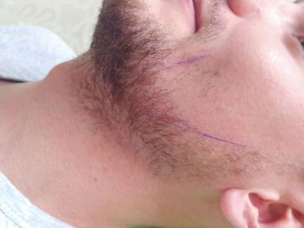 Мужская депиляция (шугаринг)